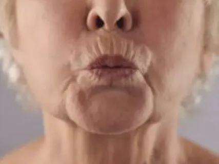 Cyclic Physiological Sighing